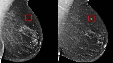 Breast Cancer Detection With AI: AI প্রযুক্তির মাধ্যমে স্তন ক্যান্সার হওয়ার ৫ বছর আগেই শনাক্ত করা সম্ভব, জেনে নিন AI প্রযুক্তির মাধ্যমে স্তন ক্যান্সার শনাক্ত করার বিষয়ে বিস্তারিত...