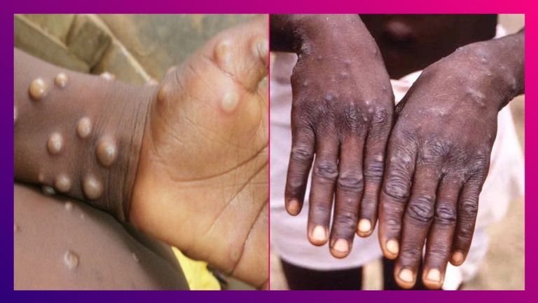 Monkeypox: মাঙ্কিপক্স নিয়ে আশঙ্কা; দেশের প্রত্যেক রাজ্য, কেন্দ্রশাসিত অঞ্চলকে সতর্ক করল কেন্দ্র