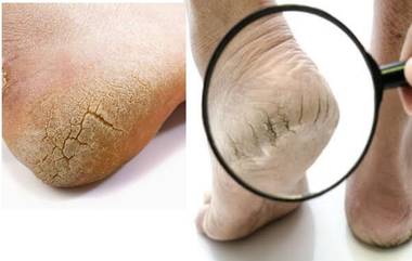 Cracked Heel Care: শীতে আরও বেড়ে যায় গোড়ালি ফাটার সমস্যা, জেনে নিন পায়ের যত্ন নেওয়ার উপায়...