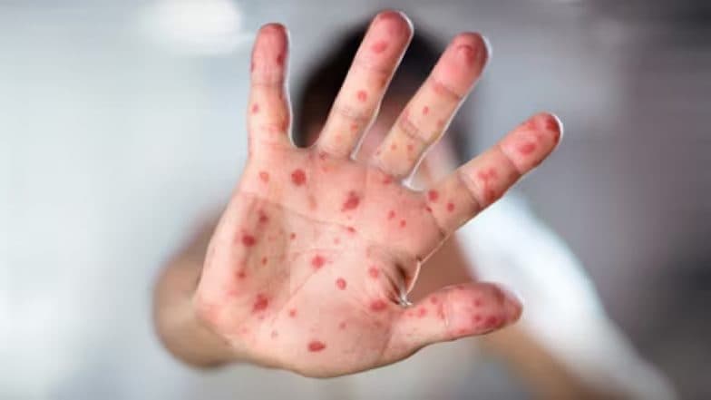 Measles Outbreak in US: টেক্সাসে হামের প্রাদুর্ভাবে শিশুর মৃত্যু, ২০১৫ সালের পর প্রথম হামে প্রথম মৃত্যু