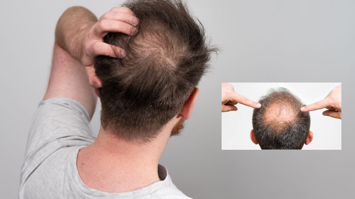Grow hair in bald: খুব সহজেই টাকে গজাবে চুল। জেনে নিন পদ্ধতি। রইল ঘরোয়া টোটকা