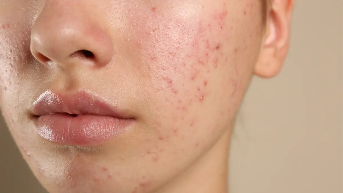 Acne problem solution: ব্রণ নিয়ে দুঃশ্চিন্তা! ব্রণ থেকে মুক্তি পেতে ঘরোয়া কিছু সমাধানও রয়েছে। দেখুন বিস্তারিত