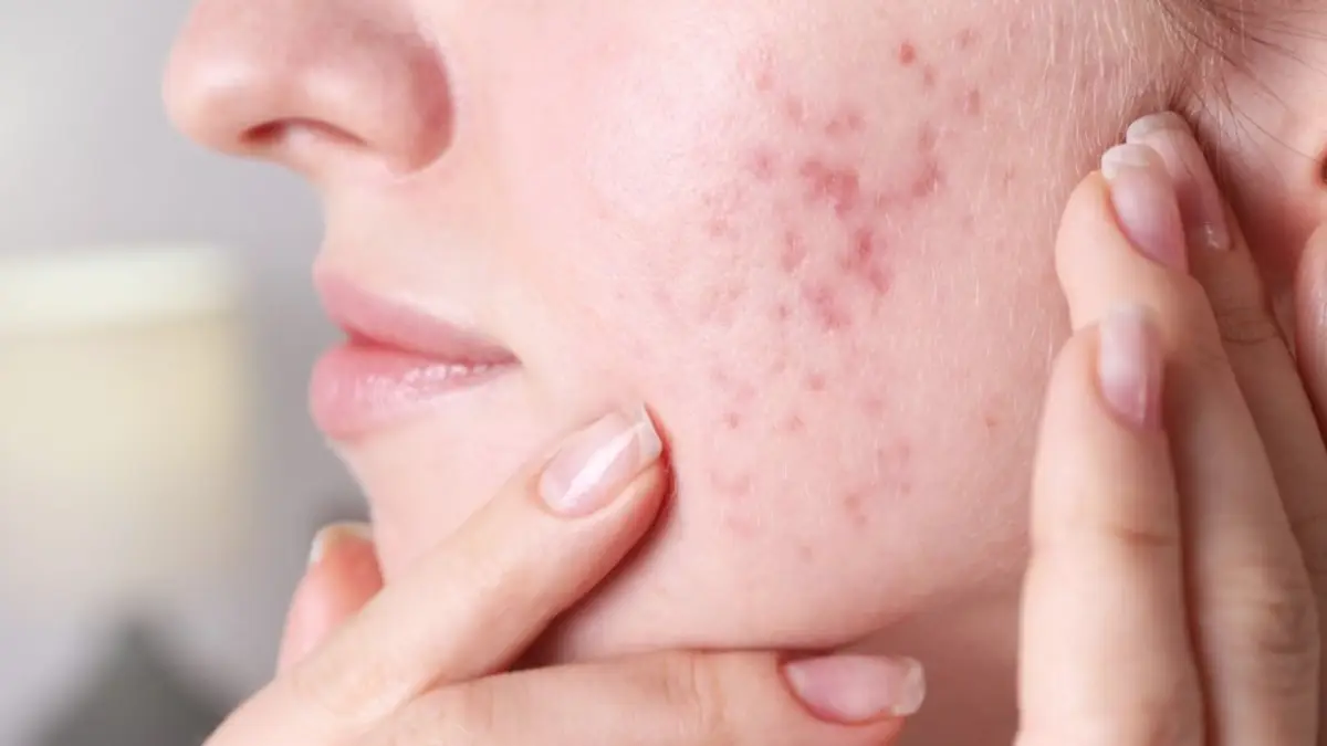 Solution to acne problems: কয়েকটি নিয়ম মানলেই উধাও হবে ব্রণ। দেখে নিন এই ঘরোয়া টোটকা