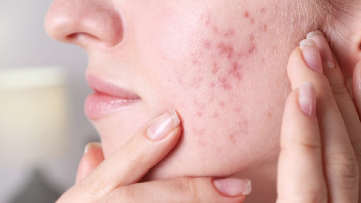 Solution to acne problems: কয়েকটি নিয়ম মানলেই উধাও হবে ব্রণ। দেখে নিন এই ঘরোয়া টোটকা