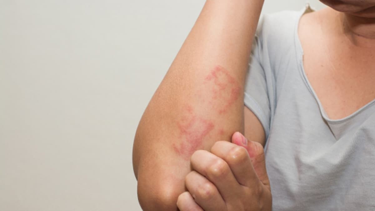Skin rash Problem: এই গরমে ত্বকে চুলকানির সমস্যা? জেনে নিন কীভাবে মুক্তি পাবেন  এই সমস্যা থেকে