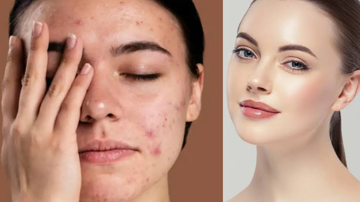 Removes dark spots: ঘাড়, গলা ও মুখের কালো দাগ দূর করুন সহজেই।‌ জেনে নিন কি করবেন