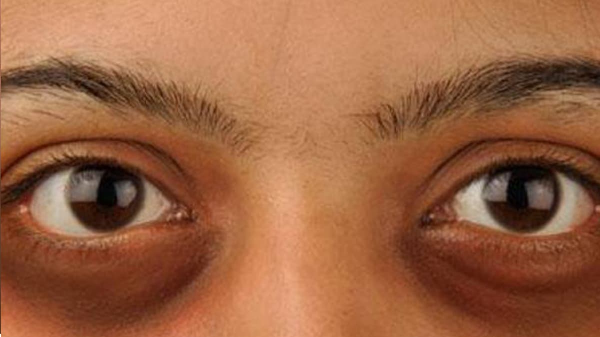 Dark Circle Remove Tips: চোখের তলায় কালো দাগ? এই ঘরোয়া উপায়ে দূর হবে দাগ