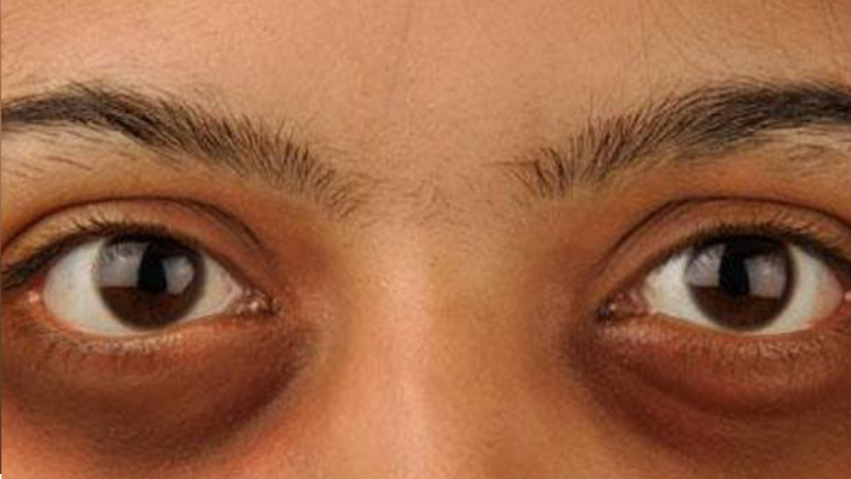 Dark Circle Remove Tips: চোখের তলায় কালো দাগ? এই ঘরোয়া উপায়ে দূর হবে দাগ