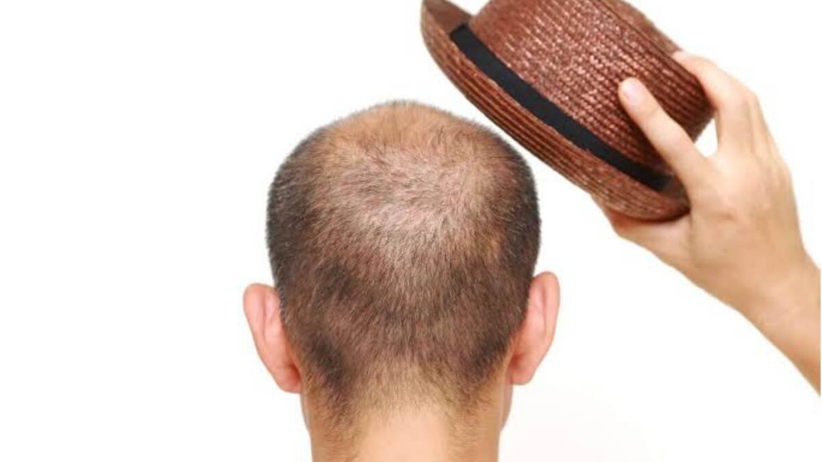Protect your bald from sun ray:   রোদে বের হলে অবশ্যই টাক ঢাকুন। তা না হলে হতে পারে ভয়ানক বিপদ