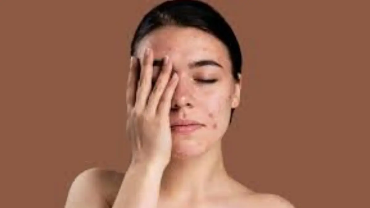 Pimple Problem: ব্রণ নিয়ে সমস্যা? মুখে ব্রণ কমাতে পারছেন না? জেনে নিন ব্রণ থেকে কিভাবে মুক্তি পাবেন। রইল ঘরোয়া উপায়