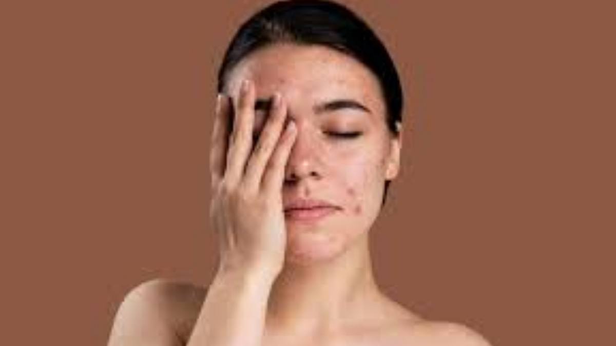 Pimple Problem: ব্রণ নিয়ে সমস্যা? মুখে ব্রণ কমাতে পারছেন না? জেনে নিন ব্রণ থেকে কিভাবে মুক্তি পাবেন। রইল ঘরোয়া উপায়