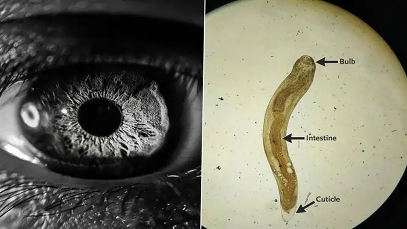 Worm In Eyes: দীর্ঘদিন ধরে চোখের সমস্যায় জেরবার, পরীক্ষা করতেই চোখের ভিতর দেখা গেল আস্ত পোকা