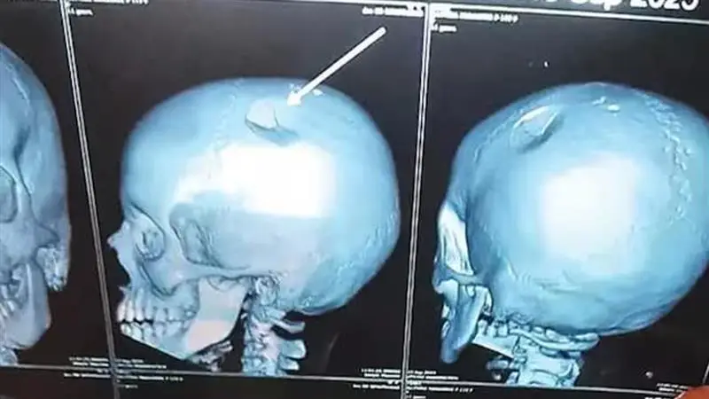 Andhra Pradesh Shocker: ক্লাসের মধ্যে 'দুষ্টুমি', রেগে ব্যাগ ছুড়ে পড়ুয়ার মাথার খুলি ভেঙে দিলেন শিক্ষিকা