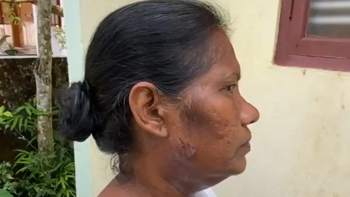 SIR: বিশেষ নিবিড় সংশোধন ফর্ম দিতে গিয়ে পোষা কুকুরের আক্রমণের শিকার বিএলও