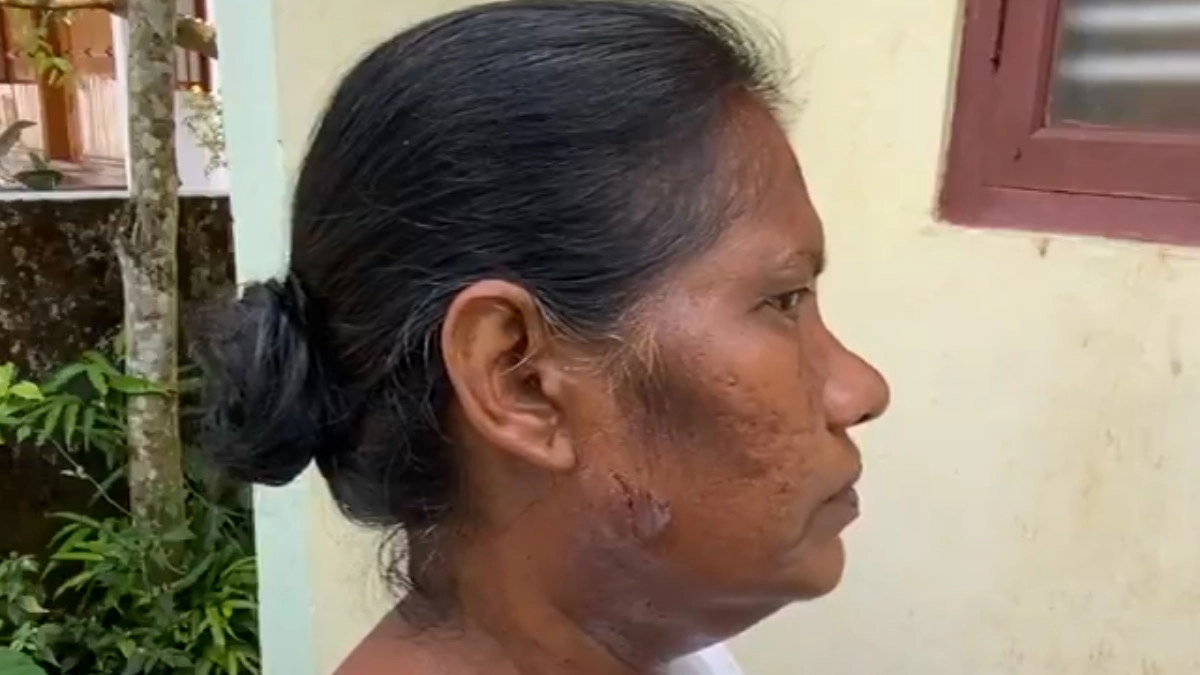 SIR: বিশেষ নিবিড় সংশোধন ফর্ম দিতে গিয়ে পোষা কুকুরের আক্রমণের শিকার বিএলও