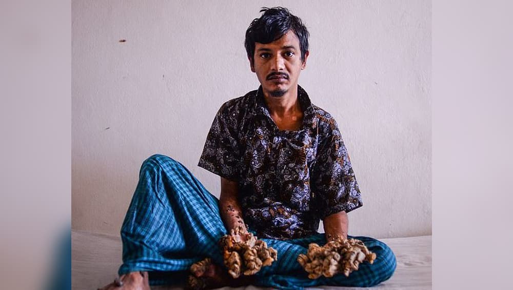 ডালপালায় ঢাকছে শরীর, রোগ মুক্তির অপেক্ষায় বাংলাদেশের গাছ মানুষ ডালপালায় ঢাকছে শরীর, রোগ মুক্তির অপেক্ষায় বাংলাদেশের গাছ মানুষ