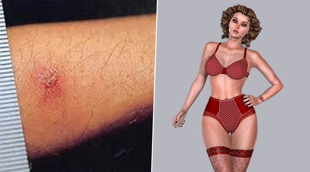 Scrub Typhus In Your Lingerie: অন্তর্বাসের ভাঁজেই বাসা বাঁধছে স্ক্র্যাব টাইফাস! জ্বর হলেই গোপনাঙ্গ পরীক্ষার পরামর্শ দিচ্ছেন চিকিৎসকরা Scrub Typhus In Your Lingerie: অন্তর্বাসের ভাঁজেই বাসা বাঁধছে স্ক্র্যাব টাইফাস! জ্বর হলেই গোপনাঙ্গ পরীক্ষার পরামর্শ দিচ্ছেন চিকিৎসকরা