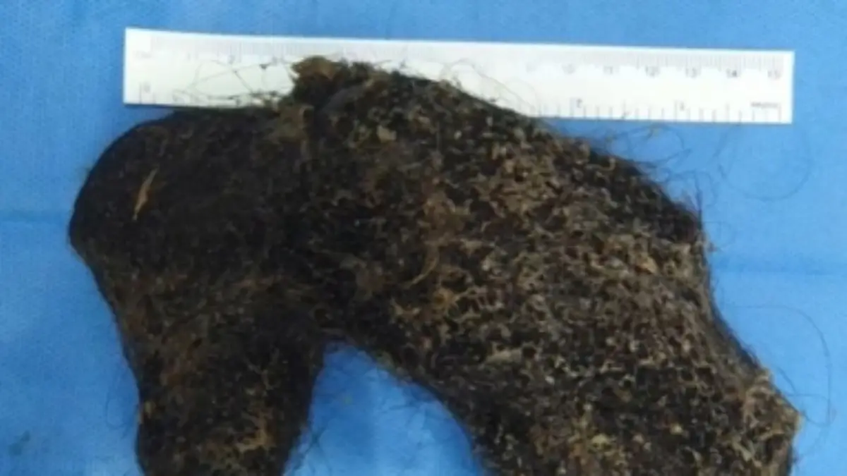 Hyderabad: ১১ বছরের মেয়ের পেট থেকে বেরলো এক দলা চুল!