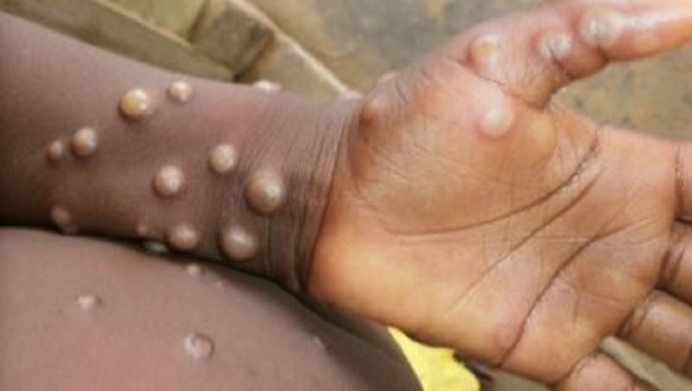 Monkeypox In Israel: এবার ইজরায়েলে মাঙ্কিপক্সের সংক্রমণ ধরা পড়ল