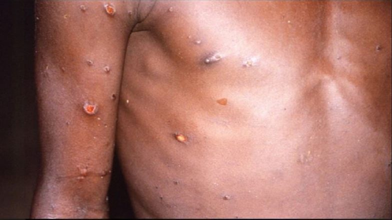 Monkeypox Cases: বিশ্বের ২০টিরও বেশি দেশে ছড়িয়ে পড়েছে মাঙ্কিপক্স, আক্রান্তের সংখ্যা বেড়ে ২০০