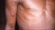 Monkeypox Cases: বিশ্বের অন্তত ১২টি দেশে মাঙ্কিপক্সের সংক্রমণ ছড়িয়েছে, মোট আক্রান্তের সংখ্যা ৮০