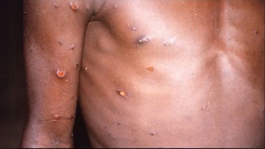 Monkeypox: ডেনমার্কেও সংক্রমণ, মাঙ্কিপক্স রুখতে ইউরোপের দেশগুলি টিকাকরণের পরিকল্পনা করুক, সতর্কতা
