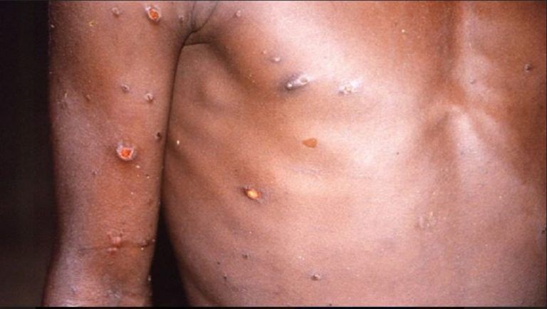 Monkeypox: মাঙ্কিপক্সে প্রথম মৃত্যু ভারতে, কেরলের থ্রিশুর জুড়ে আতঙ্ক