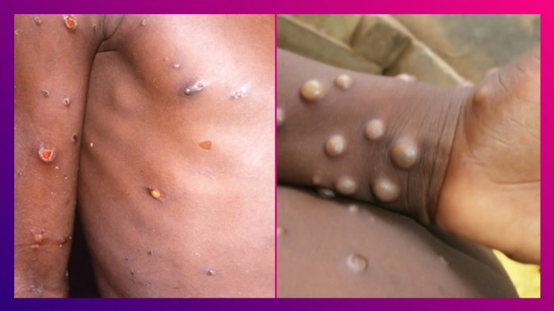 Monkey Pox Reported In Kerala: ভারতে মাঙ্কিপক্সে প্রথম সংক্রমণ, বিদেশ থেকে ফিরতেই আক্রান্ত ব্যক্তি
