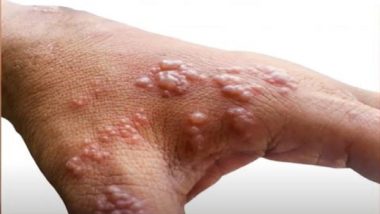 Monkeypox: কোভিডের থাবা কাটতে না কাটতেই বিশ্বের ১৯টি দেশে থাবা বসাল মাঙ্কিপক্স