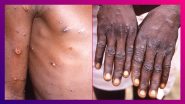 Monkeypox Cases: ছড়াচ্ছে আতঙ্ক, প্রথম মাঙ্কিপক্সের সংক্রমণ ধরা পড়ল সুইডেনে