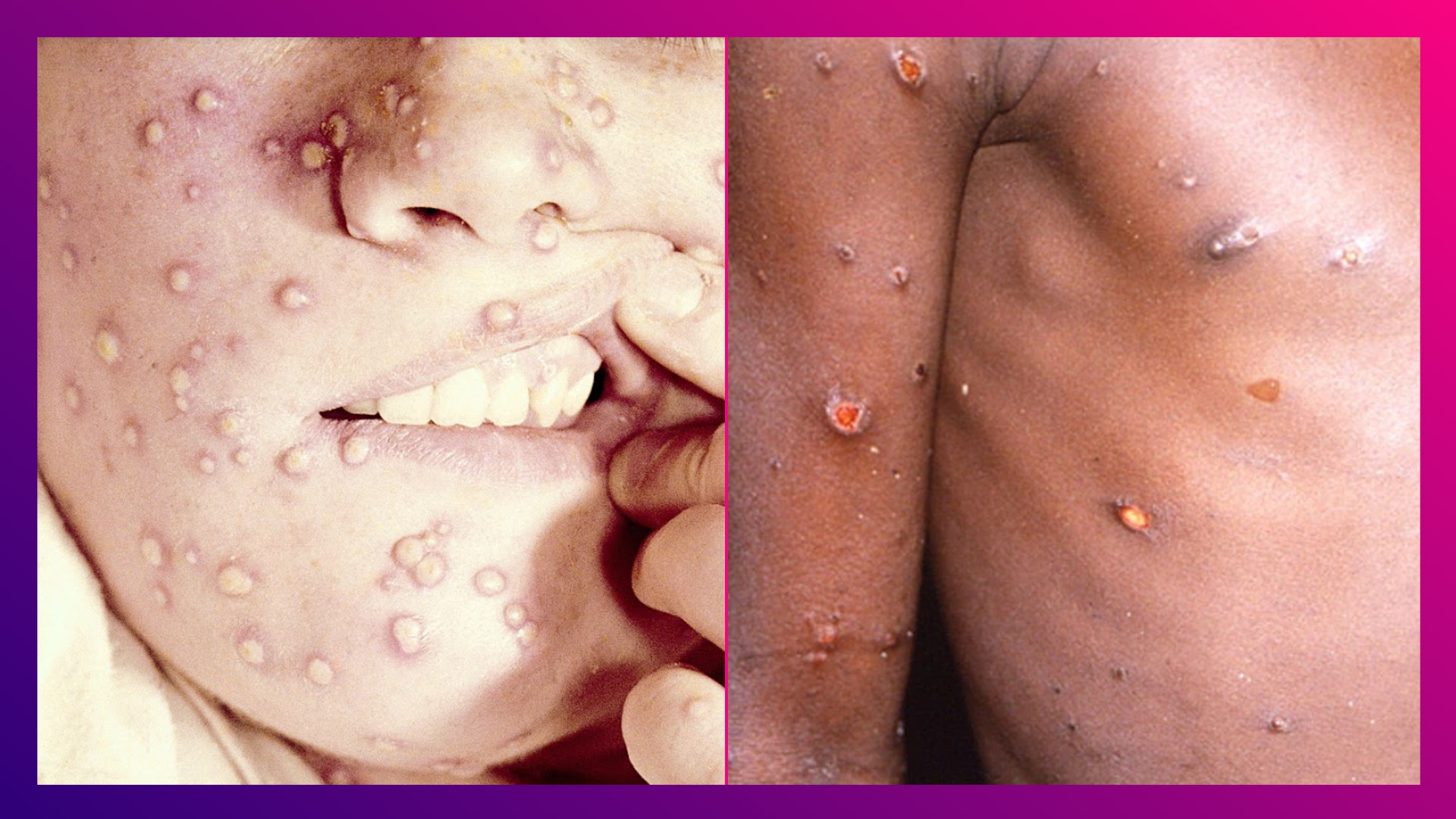 Monkeypox VS Smallpox: মাঙ্কিপক্স না স্মলপক্স? ভয়াবহতা বেশি কীসে, চিকিৎসকরা কী বলছেন দেখুন