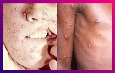 Monkeypox: সমকামী, উভকামীদের মধ্যে ছড়াচ্ছে মাঙ্কিপক্স? সতর্কতা