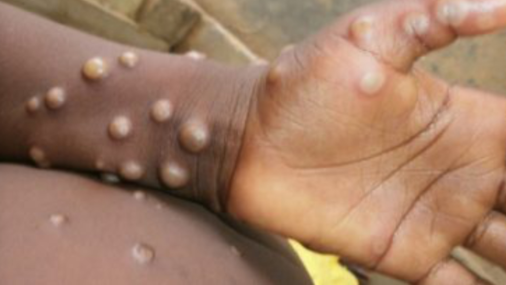 Monkeypox Outbreak: মাঙ্কিপক্সের থাবায় আমেরিকা, সংক্রামিত ৭২