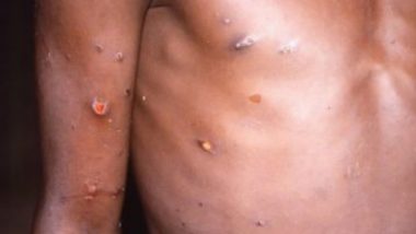 Monkeypox In Australia: এবার অস্ট্রেলিয়ায় মাঙ্কিপক্স, আক্রান্ত সম্প্রতি ইউরোপ থেকে ফিরেছেন
