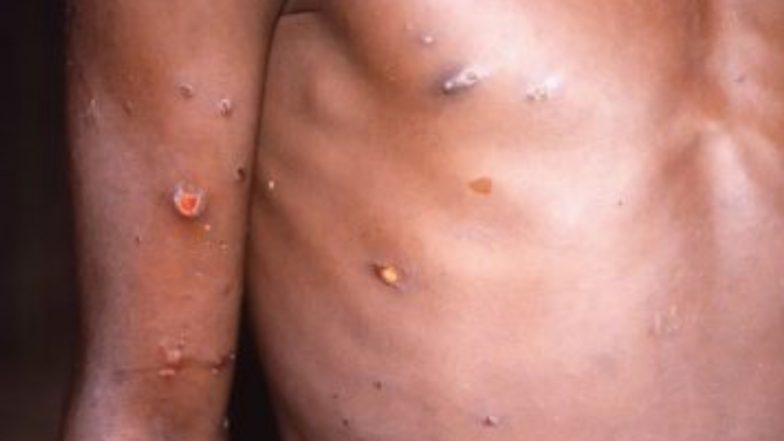 Monkeypox Outbreak: আমেরিকা থেকে কানাডা, ইংল্যান্ড থেকে স্পেন দ্রুত ছড়াচ্ছে মাঙ্কিপক্স