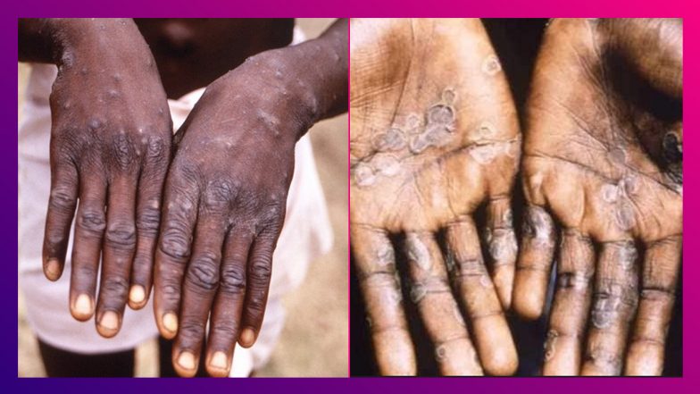 Monkeypox: ভয় ধরাচ্ছে সংক্রমণ, মাঙ্কিপক্স নিয়ে গ্লোবাল পাবলিক হেলথ এমার্জেন্সি ঘোষণা WHO-এর