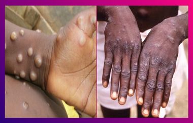 Monkeypox: মাঙ্কিপক্স নিয়ে আশঙ্কা; দেশের প্রত্যেক রাজ্য, কেন্দ্রশাসিত অঞ্চলকে সতর্ক করল কেন্দ্র