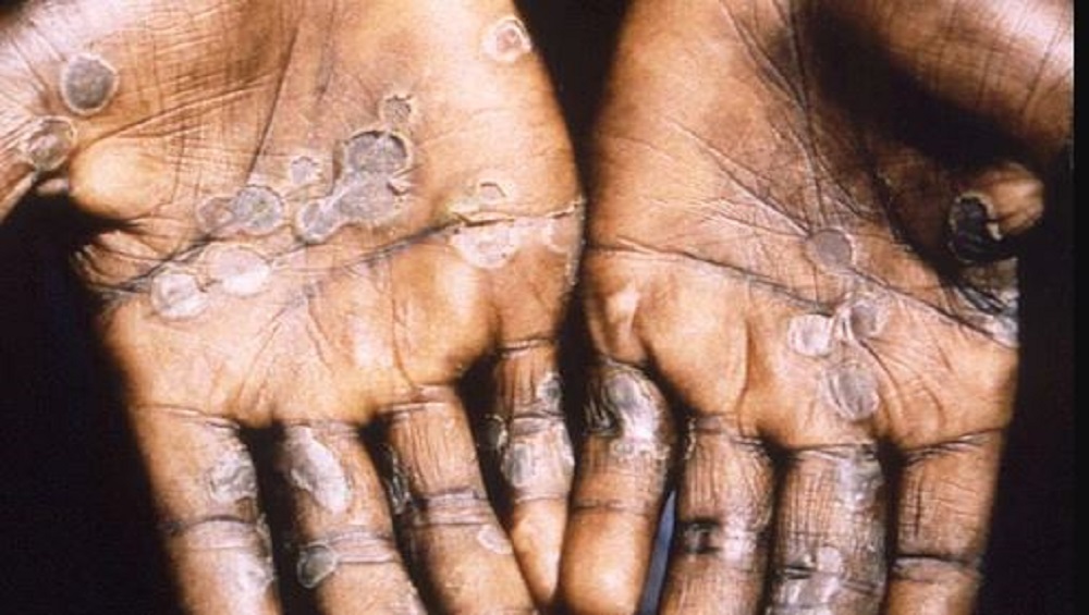 Monkeypox: ভারতে মাঙ্কিপক্সে প্রথম মৃত্যু,পরিস্থিতি খতিয়ে দেখতে টাস্ক ফোর্স গঠন কেন্দ্রের
