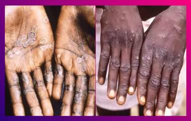 Monkeypox: বাড়ছে আতঙ্ক, আফ্রিকার ১৩টি দেশে মাঙ্কিপক্সে সংক্রমিত ৬,৮৮৩ জন