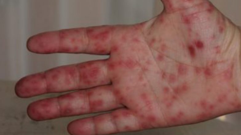 Centre Sends Advisory On Tomato Flu: টোম্যাটো ফ্লুর সঙ্গে সারস কভ ২, চিকুনগুনিয়া, মাঙ্কিপক্সের যোগ নেই, জানাল কেন্দ্র