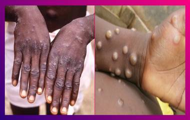 Monkeypox: কেরলে ফের মাঙ্কিপক্সের হানা, আতঙ্ক দক্ষিণে