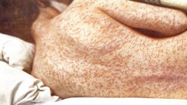 Measles: মহারাষ্ট্রে হু-হু করে বাড়ছে হামের প্রকোপ, কী এই হাম? কীভাবে এর প্রতিকার সম্ভব? জানুন
