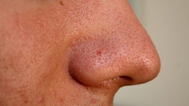 Pimple Diagnosed With Cancer: মুখের মধ্যে ঘন ঘন ব্রণর সমস্যা! সাবধান হতে পারে ক্যানসার