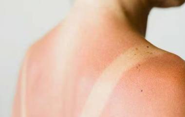 Sunburn : সানবার্নের সমস্যায় নাজেহাল? দেখে নিন প্রতিকার